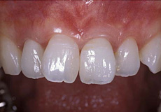なぎさ歯科クリニック 歯周形成外科 治療後