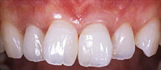 なぎさ歯科クリニック 審美歯科　ホワイトニングの症例
