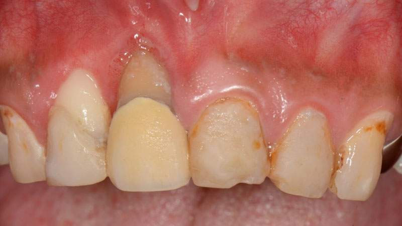 なぎさ歯科クリニック 歯冠修復 症例紹介1 治療前1
