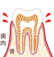 なぎさ歯科クリニック 歯肉炎