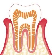 なぎさ歯科クリニック 軽度歯周病