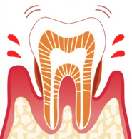 なぎさ歯科クリニック 中度歯周病