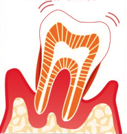 なぎさ歯科クリニック 重度歯周病