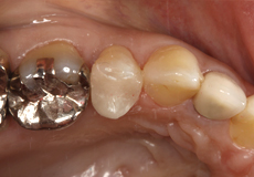 なぎさ歯科クリニック セラミック修復　セレックを使用した症例