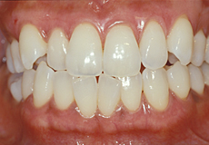 なぎさ歯科クリニック 審美歯科　メラニン除去（歯肉の漂白）