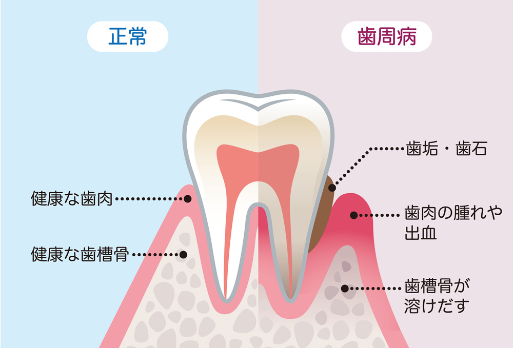 なぎさ歯科クリニック 歯周病とは？