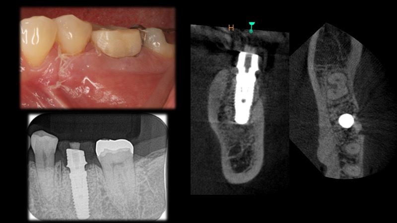 なぎさ歯科クリニック 抜歯即時インプラント治療　症例紹介