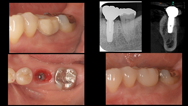 なぎさ歯科クリニック 抜歯即時インプラント治療　症例紹介