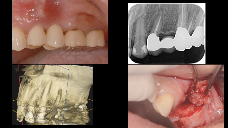 なぎさ歯科クリニック 抜歯即時インプラント治療　症例紹介