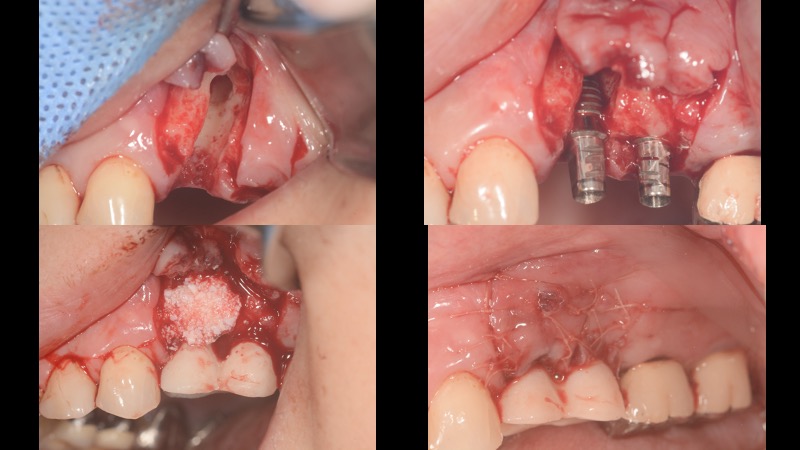なぎさ歯科クリニック 抜歯即時インプラント治療　症例紹介