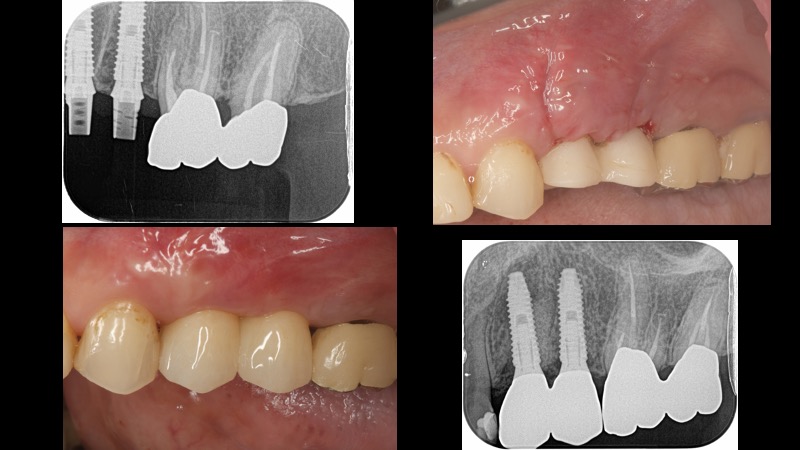 なぎさ歯科クリニック 抜歯即時インプラント治療　症例紹介