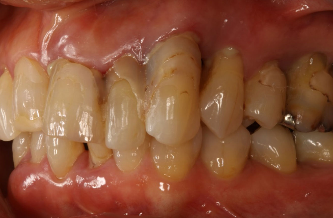 なぎさ歯科クリニック 歯周病治療　症例紹介