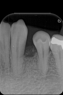 なぎさ歯科クリニック 歯周再生療法 症例紹介