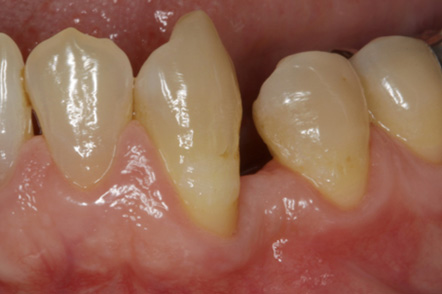 なぎさ歯科クリニック 歯周再生療法 症例紹介 術後10年経過