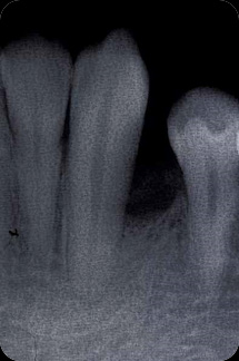 なぎさ歯科クリニック 歯周再生療法 症例紹介