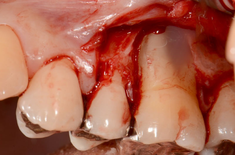 なぎさ歯科クリニック 歯周再生療法 症例紹介 治療前2
