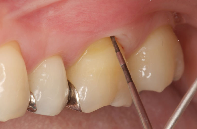 なぎさ歯科クリニック 歯周再生療法 症例紹介 治療前1