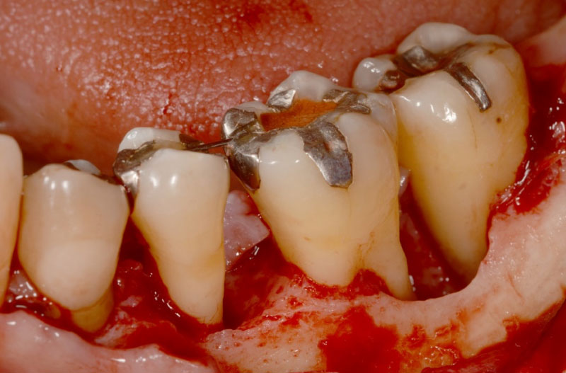 なぎさ歯科クリニック 歯周再生療法 症例紹介 治療前1