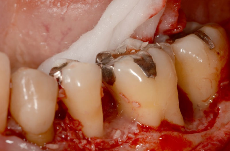 なぎさ歯科クリニック 歯周再生療法 症例紹介 治療前2