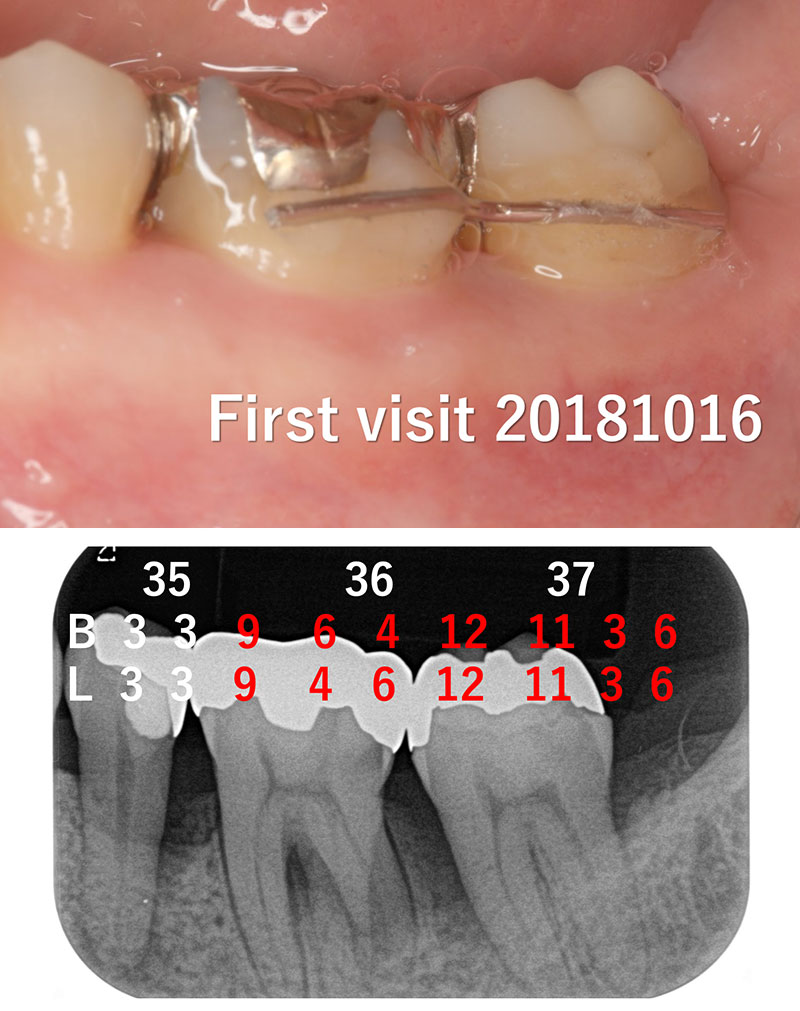 なぎさ歯科クリニック 歯周再生療法 症例紹介 治療前1