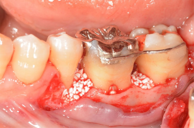 なぎさ歯科クリニック 歯周再生療法 症例紹介 治療前1