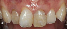 なぎさ歯科クリニック 審美歯科　ホワイトニングの症例