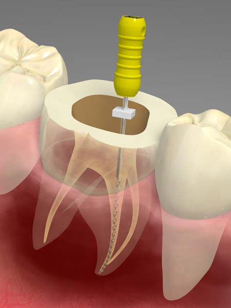 なぎさ歯科クリニック 汚染部分の確実な除去に重要なニッケルチタンファイルの使用