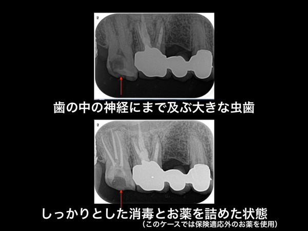 なぎさ歯科クリニック 根管治療