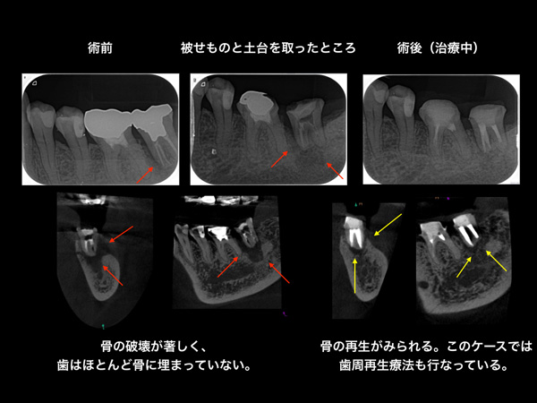 なぎさ歯科クリニック 根管治療 治療後