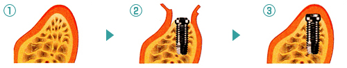 なぎさ歯科クリニック 外科的処置・インプラント埋入