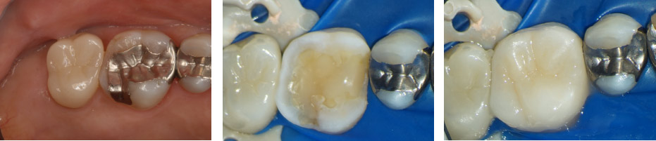 なぎさ歯科クリニック セラミック修復　セレックを使用した症例