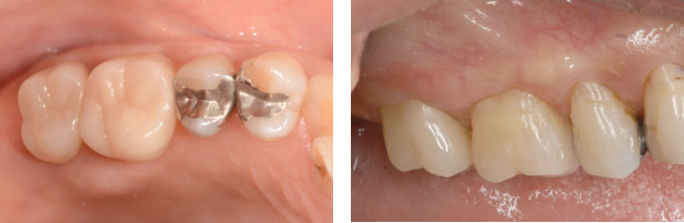 なぎさ歯科クリニック セラミック修復　セレックを使用した症例