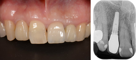 なぎさ歯科クリニック インプラント治療　症例紹介