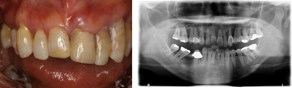 なぎさ歯科クリニック インプラント治療　症例紹介