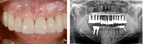 なぎさ歯科クリニック インプラント治療　症例紹介