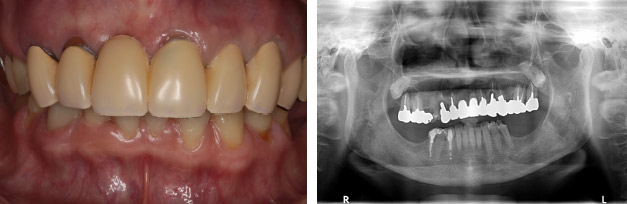 なぎさ歯科クリニック インプラント治療　症例紹介