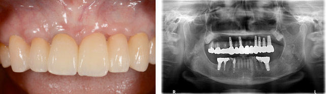 なぎさ歯科クリニック インプラント治療　症例紹介