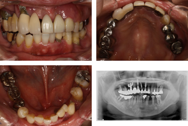 なぎさ歯科クリニック インプラント治療　症例紹介