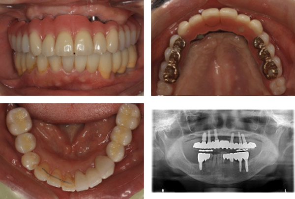 なぎさ歯科クリニック インプラント治療　症例紹介