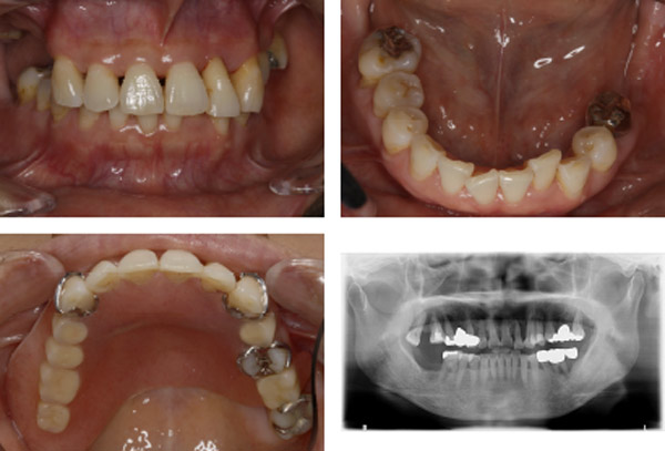 なぎさ歯科クリニック インプラント治療　症例紹介