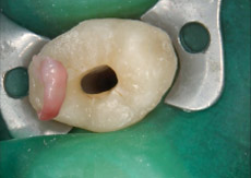 なぎさ歯科クリニック 歯牙移植