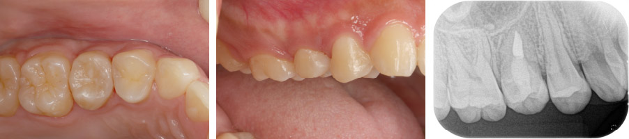 なぎさ歯科クリニック 歯牙移植